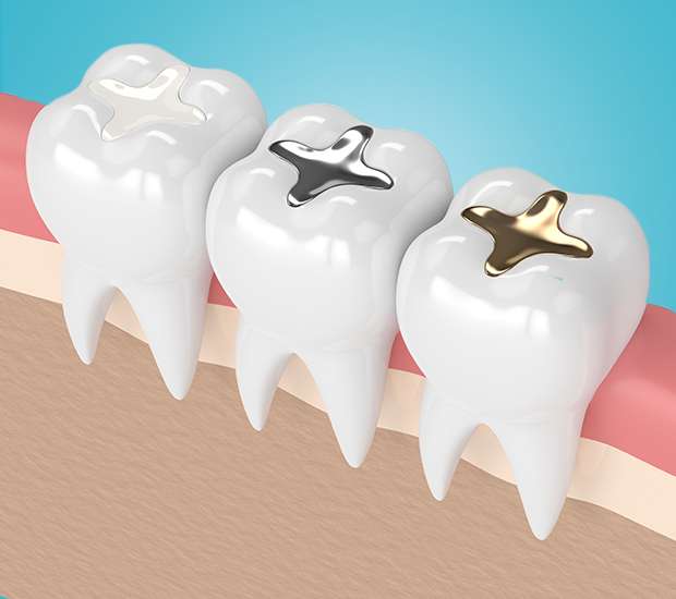 Auburn Hills Tooth Colored Fillings