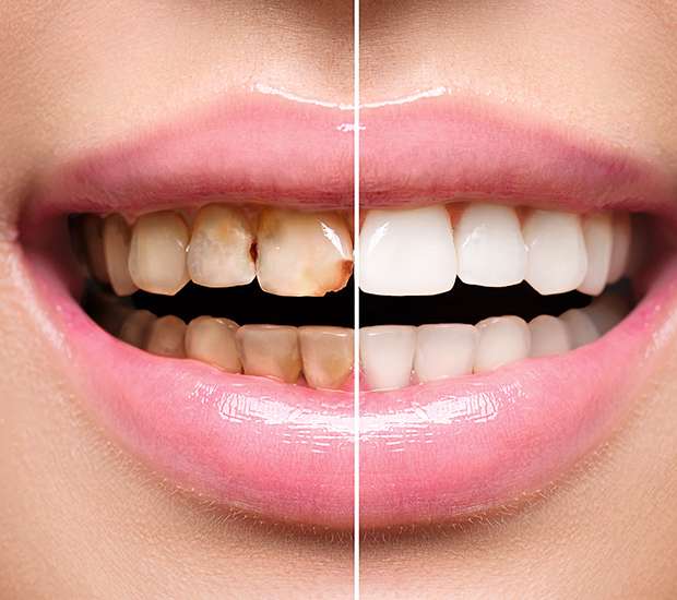 Auburn Hills Dental Implant Restoration