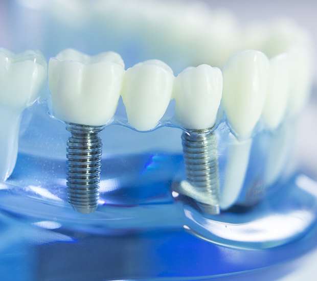 Auburn Hills Dental Prosthetics